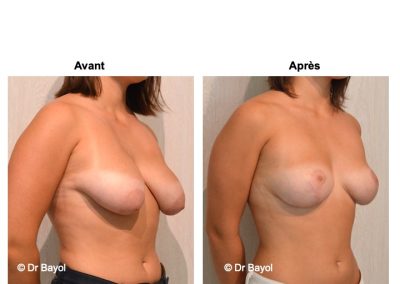 tarifs lifting des seins