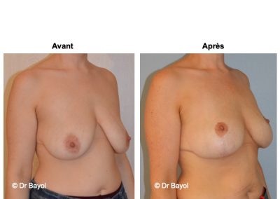 tarifs lifting des seins Lyon