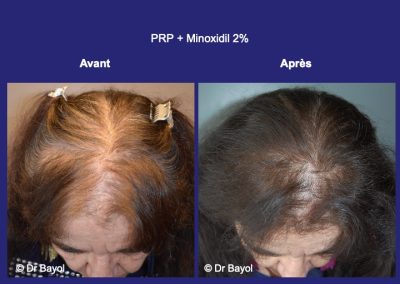 traitement médical chutte de cheveux femme