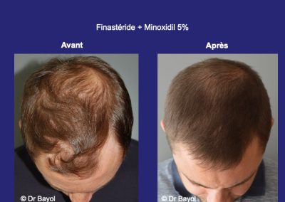 traitement médical de l'alopécie