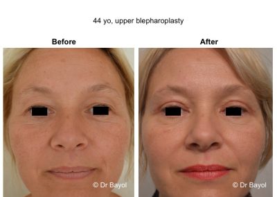 upper blepharoplasty