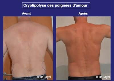 cryolipolyse CoolSculpting lyon