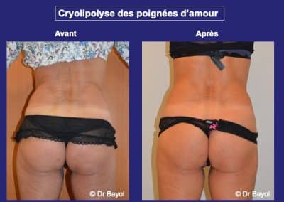 cryolipolyse Lyon