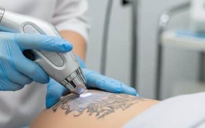 Le détatouage laser est-il douloureux et comment atténuer l&rsquo;inconfort ?